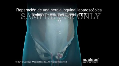 como es una hernia inguinal